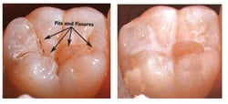Fissure sealants protect your child's molars
